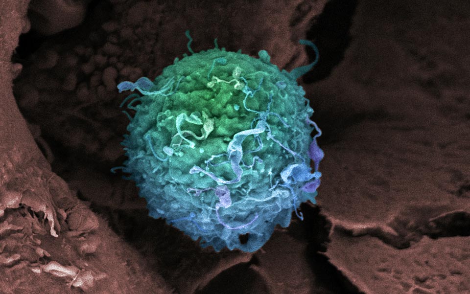 A false-colour, scanning-electron microscope image of a breast cancer cell.  Photo by Science Photo Library/Getty.
