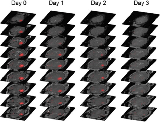 Reversible blood-brain barrier opening using focused ultrasound.  Shown are horizontal consecutive slices of the brain, corresponding to contrast enhanced T1 images from day 0 (when focused ultrasound was applied) to day 3 (when closing occurred). Overlaid with red color are the voxels where the MRI contrast agent (Gd-DTPA in this case) had diffused through the BBB. The left hippocampus was not sonicated and so the contrast agent remained in the vasculature, while in the sonicated hippocampus on the right, the contrast agent diffused into the brain parenchyma until the BBB completely closed on day 3. Source: Samiotaki et al. (2012)