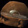 Clinical guidelines set for deep brain stimulation for obsessive-compulsive disorder.