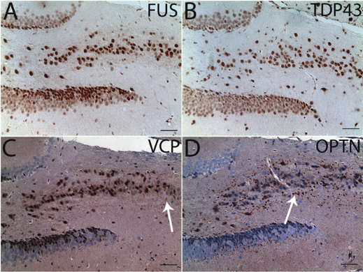 ALS- and frontotemporal dementia (FTD)-associated proteins in transgenic mice.  Immonohistochemtry (A–D) and confocal microscopy.  Relatively weak VCP- and strong OPTN-immunoreactive aggregates were present in the hippocampus (C and D, indicated by arrows). Hematoxylin was not used for FUS (A) and TDP43 (B) immunohistochemistry to avoid masking nuclear staining of these two proteins.  Dendritic spinopathy in transgenic mice expressing ALS/dementia-linked mutant UBQLN2.  Siddique et al 2014.