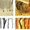 Schizophrenia, bipolar disorder linked with dendritic spine loss in brain.