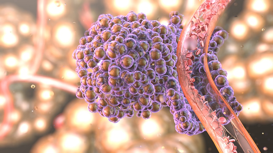 Cancer metastasis animation.  © 2014 Nanobotmodels Medical Animation. medical animation studio 
