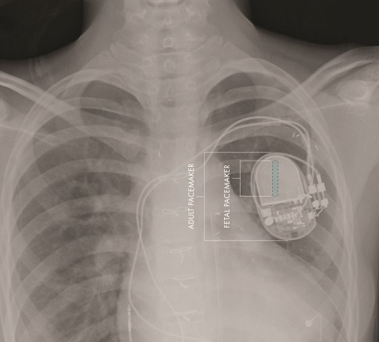 Comparative sizes of fetal and adult pacemakers.  Credit: Image courtesy of Children's Hospital Los Angeles Saban Research Institute.