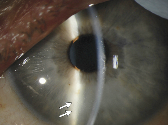 Slit-Lamp Photograph of the Left Eye 14 Weeks after the Onset of Ebola Virus Disease.  Mild corneal edema, rare keratic precipitates (arrows), and inflammatory cells and protein in the anterior chamber are consistent with acute anterior uveitis.  Persistence of Ebola Virus in Ocular Fluid during Convalescence.  Yeh et al 2015.