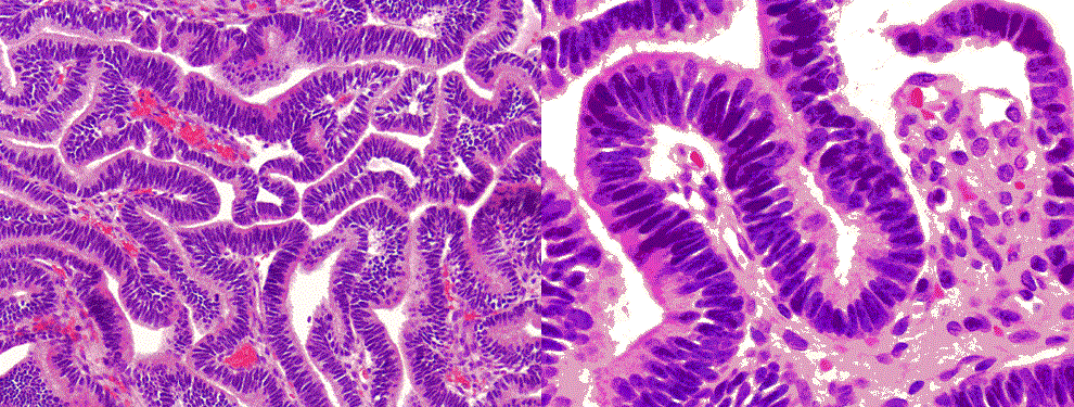 Choroid plexus carcinoma:  Both panels are taken from the same tumor: In comparison to choroid plexus papilloma, the cells in choroid plexus carcinoma are more densely packed. They also have enlarged nuclei and hyperchromatic nuclei. Mitotic figures are readily seen. In this case, the papillary structure is maintained.  Credit:   Department of Pathology, University of Oklahoma Health Sciences Center.  