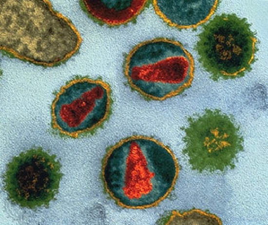 First case of prolonged remission (12 years) in an HIV-infected child - healthinnovations