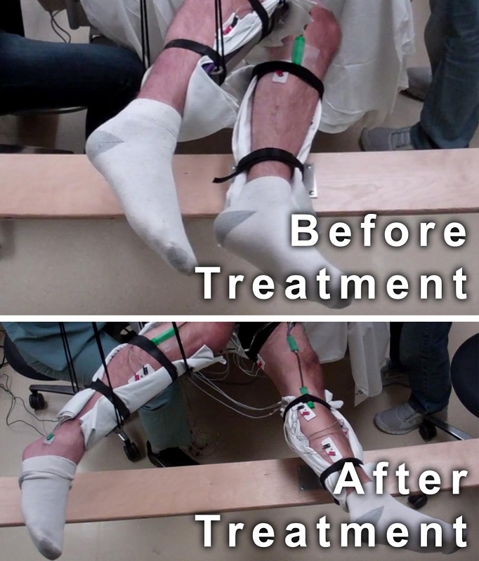 This image shows the range of voluntary movement prior to receiving stimulation compared to movement after receiving stimulation, physical conditioning, and buspirone. The subject's legs are supported so that they can move without resistance from gravity. The electrodes on the legs are used for recording muscle activity. Credit: Edgerton lab/UCLA. 