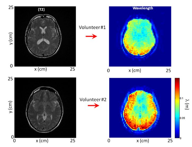 Comparison between two volunteers of (Left) the axial view of the T2-weighted image and (Right) its corresponding shear-wavelength tomography.  The tomography on volunteer 2 was acquired 1 mo after the one presented in the manuscript. Although in different regions of the brain, the similarity between reconstructions is striking.  Brain palpation from physiological vibrations using MRI.  Catheline et al 2015.