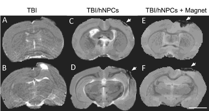 Detection of magnetic enhanced retention of MIRB-hNPCs following TBI by MRI. (A-B) In vivo T2WI of TBI rats 2h after CCI and before MIRB-hNPC transplantation; animals were not wearing a magnetic hat. The region of increased signal contrast in (B) is due to edema. (C-D) Ex vivo T2WI 5d after MIRB-hNPC transplantation in TBI-controls not wearing a magnetic hat. A small decrease in signal contrast was seen at the site of injury. (E-F) Ex vivo T2WI in TBI-rats wearing a magnetic hat. An extensive decrease in signal contrast was found. The location of the loss of signal contrast was confirmed by Perls’ Prussian blue staining and with immunocytochemistry of MIRB-hNPCs with human specific SC121 antibody. Cell-based therapy in TBI: Magnetic retention of neural stem cells in vivo. Yarowsky et al 2015.