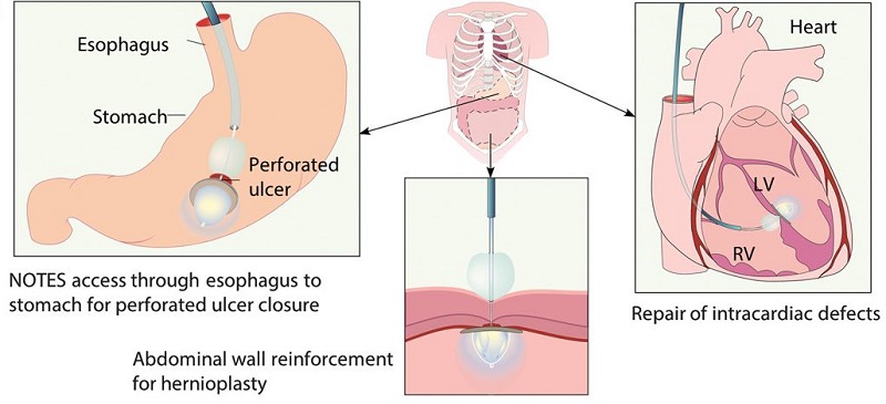 A transcatheter light-reflecting technology that delivers and activates a photocurable adhesive.  Artistic representation of potential applications for the device, including repair of perforated peptic ulcer, abdominal wall, and intracardiac defects.  A light-reflecting balloon catheter for atraumatic tissue defect repair.  del Nido et al 2015.
