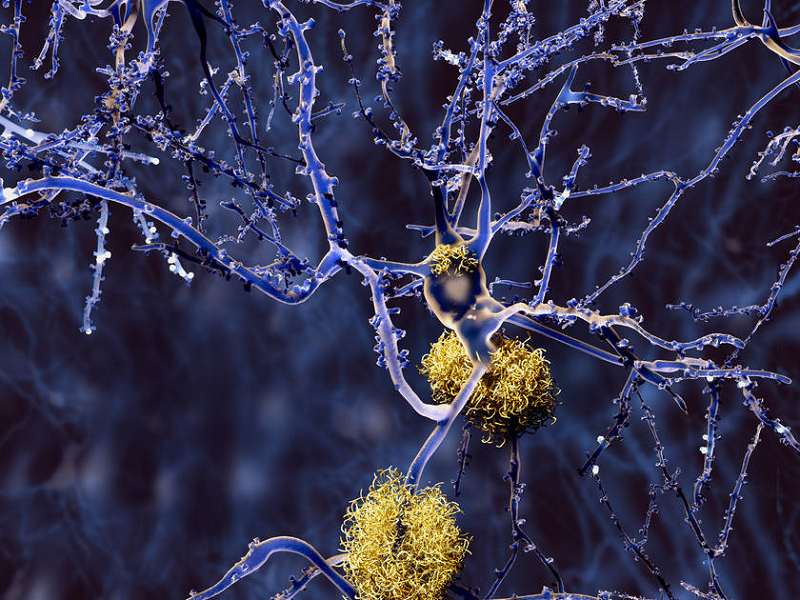 Swedish diagnostic method for Alzheimer's becomes international standard - neuroinnovations