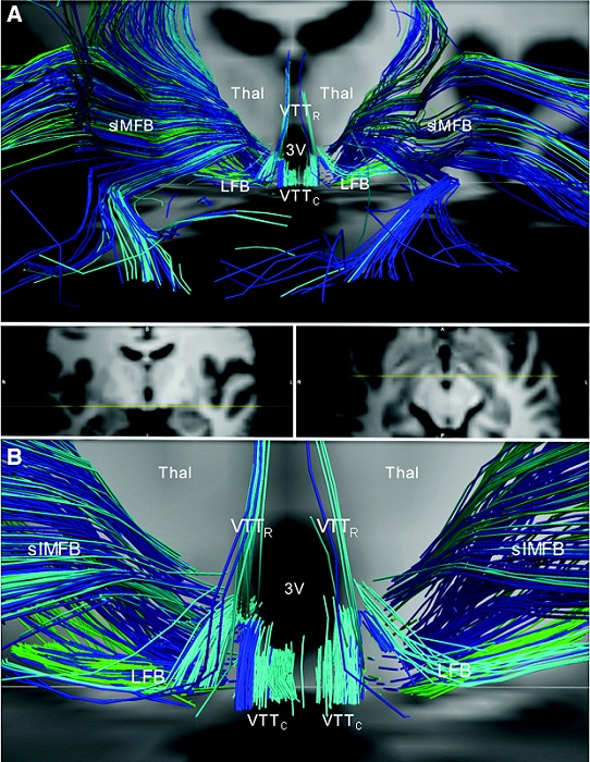 Divergence of the medial forebrain bundle, LFB, and ventral tegmental tracts in the posterior hypothalamus. (A) Anterior view of streamlines generated from the locus coeruleus (dark blue), dorsal raphe (turquoise), and median raphe (green) superimposed upon axial and coronal T1-weighted images (center inset) for a representative subject. In the posterior hypothalamus, streamlines from the locus coeruleus, dorsal raphe, and median raphe diverge as the follows: (1) slMFB, connecting to the prefrontal cortex; (2) VTTR, connecting to the paraventricular nuclei of the thalamus (Thal); (3) the VTTC, connecting to the anterior hypothalamus and basal forebrain, running alongside the imMFB; and (4) LFB, connecting to temporal limbic sites. (B) Zoomed view of the image in (A) demonstrates the divergence of the slMFB, VTTR, VTTC, and LFB in the posterior hypothalamus. Anatomic landmark; third ventricle (3V).  The Structural Connectome of the Human Central Homeostatic Network.  Edlow et al 2015.