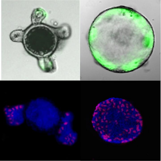 Duke scientists grew two sets of cellular "miniguts" on culture dishes and stimulated them with inflammatory factors. The miniguts on the left are normal. But on the right, the deletion of a MicroRNA called miR-34a causes stem cells (green markers in the top right image and red markers in the bottom right image) to divide out of control. This causes the minigut to bloat into a cancerous sphere.  Credit: Xiling Shen, Duke University.