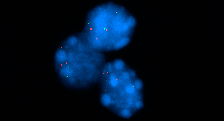 Visualizing the number of copies of ATG5 in melanoma cells. The image corresponds to nucleus (in blue) of melanoma cells stained for FISH (fluorescence in situ hybridization). The red dots correspond to ATG5 and the green ones to another gene in the same chromosome. Note the reduced number of ATG5 (red dots)./ CNIO.