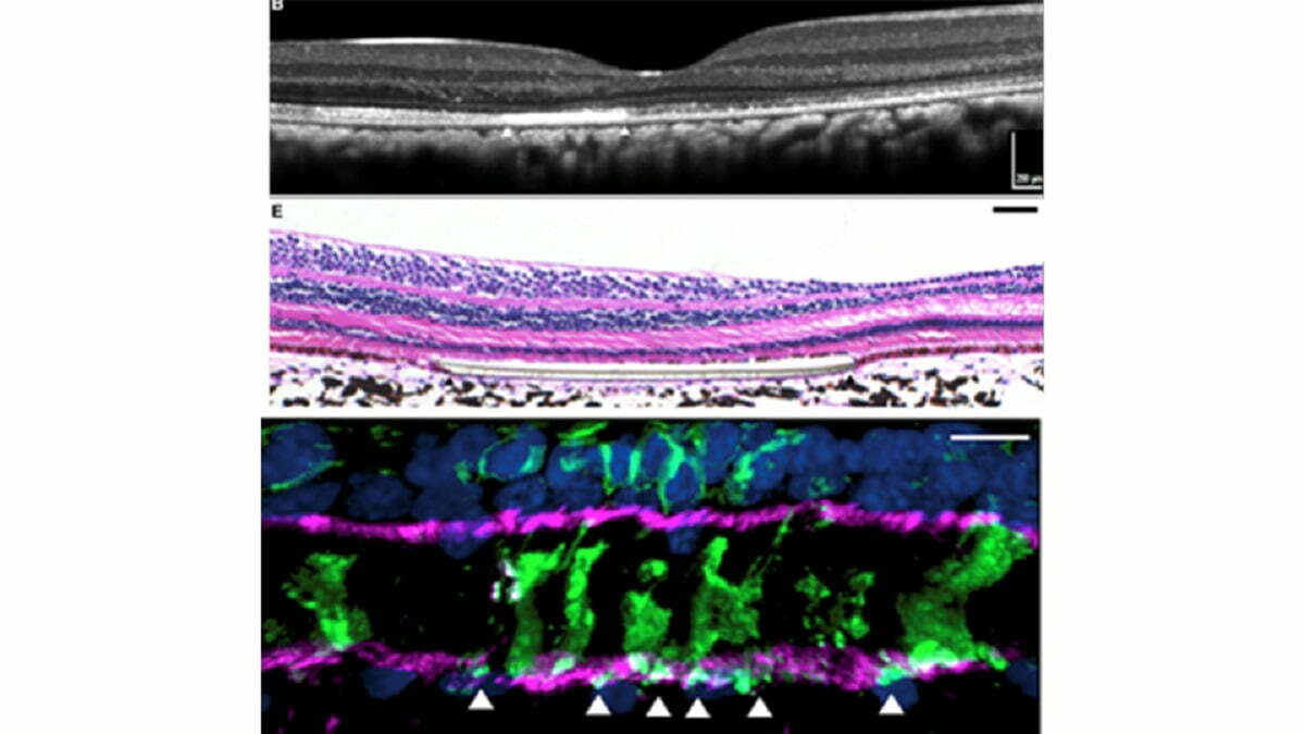 art work for Retinal cell transplant clears experimental hurdle toward treating blindness written by Healthinnovations