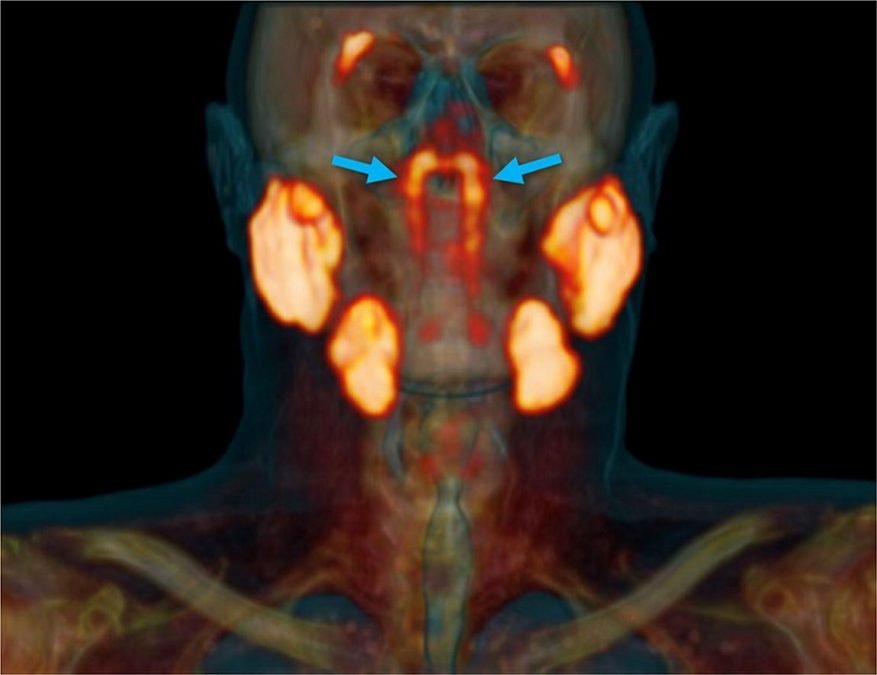 Researchers discover a new organ with vast implications for cancer patients. The blue arrows denote the newly discovered tubarial glands.